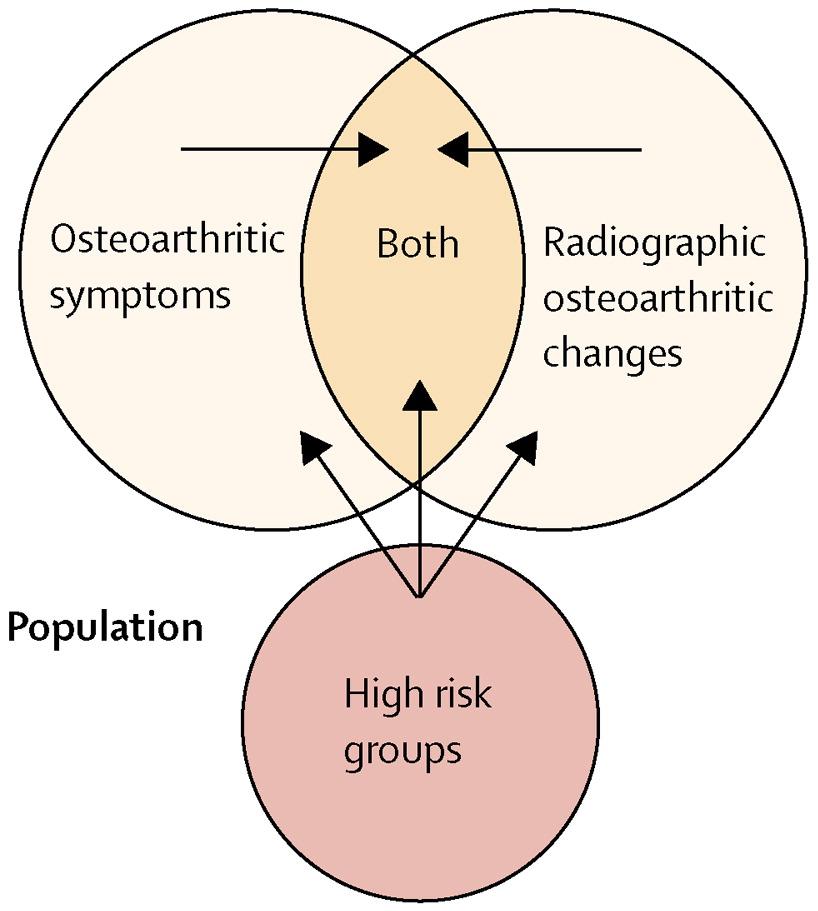 Diagnosis of Osteoarthritis Some people have risk factors for osteoarthritis, but no disease; some have radiographic changes but no symptoms; and some have symptoms