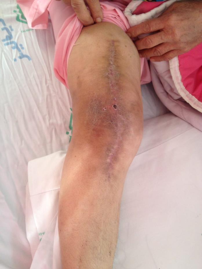 prior surgical incision is opened Irrigation Debridement of any necrotic or infected soft tissue Removal of any encountered hematoma
