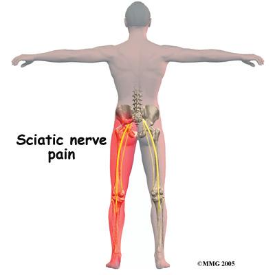 The sciatic nerve stays irritated and continues to be a problem. Eventually the muscle heals, but some of the muscle fibers inside the piriformis muscle are replaced by scar tissue.