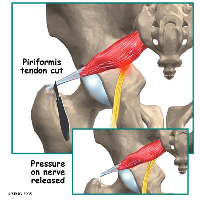 piriformis muscle and tendon can be seen, the surgeon then cuts (releases) the tendon where it connects to the greater trochanter.
