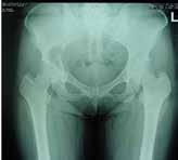A C D Figure 2. A 36-year-old female with a 6-month history of pain in the right hip while walking. A) Radiography showed osteolytic changes in the right acetabulum.