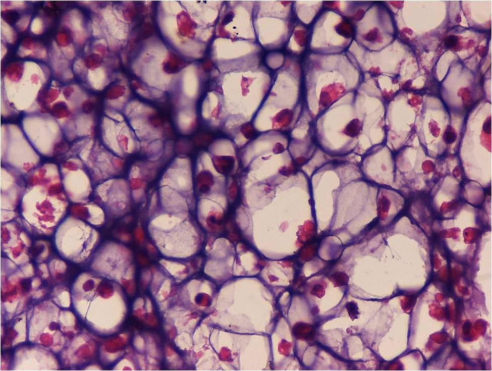 Figure 2: Chondrosarcoma: Histopathologic Examination Showed a Clear Cell Variant of