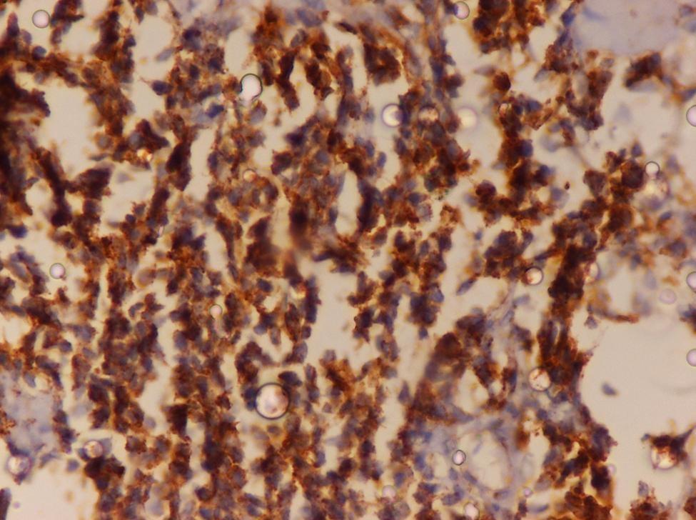 With Small Trabeculae Of Woven Bone H and E x 40 Figure 3: Ewing s Sarcoma: Tumor Cell