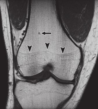 Fig. 3 Minute enchondroma or cartilage rest in distal femur of 33-year-old man with knee pain associated with quadriceps and patellar tendon tendinopathy.