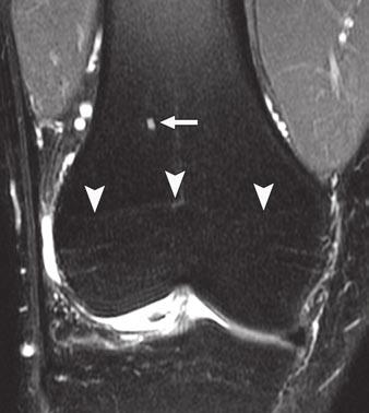 distal femoral metadiaphysis (arrows). Lesion reveals minimally lobulated margins on T2-weighted image and is more than 1.5 cm from physeal scar (arrowheads).