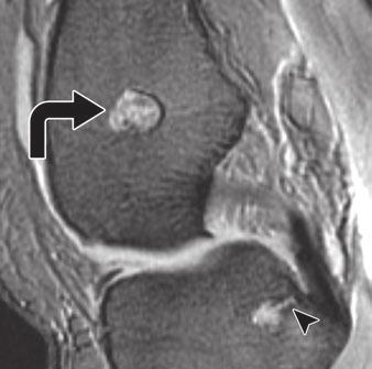 The lesions were located in the metaphysis in 71% (n = 10) (Figs. 1, 4, and 5) of cases, in the epiphysis in 7% (n = 1), and in the diaphysis in 21% (n = 3) (Fig. 2).