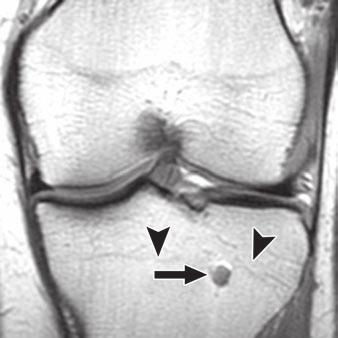 Fig. 5 Incidental enchondroma in proximal tibia of 32-year-old woman with meniscal tear.