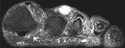 Figure 2 Figure 4 (b) The nodule demonstrates high T2 signal intensity on the fat saturated T2-weighted image.