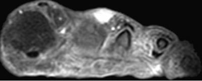 Figure 3 (c) Homogeneous enhancement is visualized on the fat saturated T1-weighted image obtained after administration of intravenous gadolinium contrast.