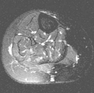 Follow-up examinations are necessary to document stability or decrease in nodularity of the resection site (Fig. 3).