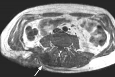 resulting in tumor nodules that mimic postoperative seromas (Fig. 5).