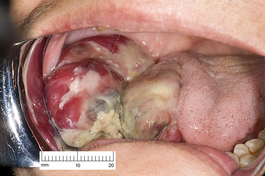 Mucosal