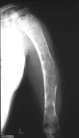 Expansile lesions Multiple myeloma Mets Aneurysmal bone cyst