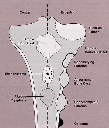 Osteosarcoma Parosteal sarcoma Osteochondroma