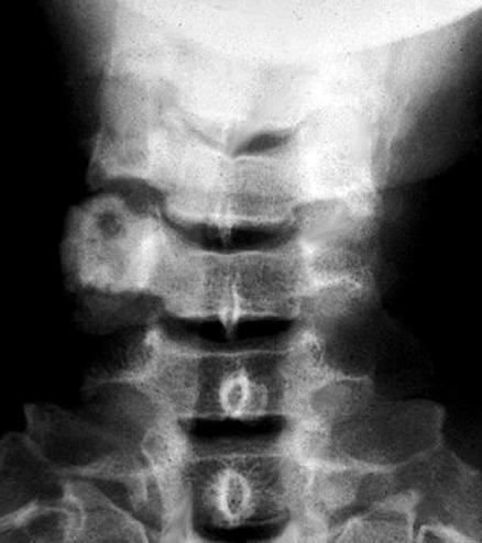 Spine lesions Osteoblastoma Chordoma ABC