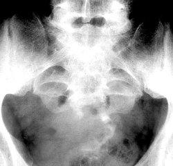 Spine lesions Osteoblastoma Chordoma