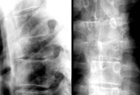 Spine lesions Osteoblastoma Chordoma ABC