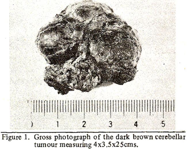Sectioning of the tumour revealed brownish solid substance with several cystic spaces of varying sizes, some of which contained yellowish fluid.