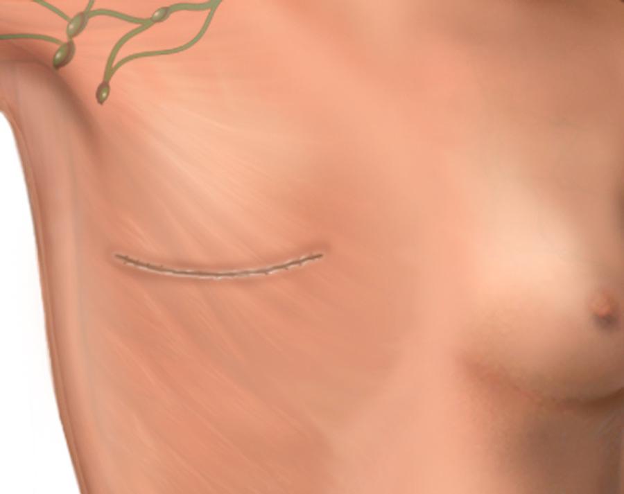 Lymph nodes Figure 1 An elliptical cut is made in the breast The direction of the cut depends on where the cancer is. Your surgeon will remove your breast tissue.