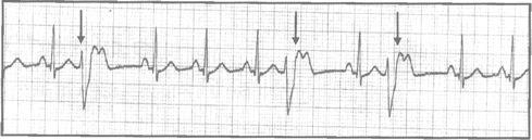 Normal and Abnormal Heart Rhythms Ectopic focus: A portion of myocardium node is irritable and can fire independently.