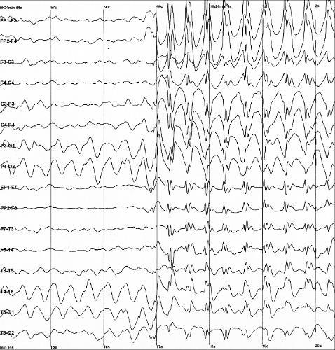 Epilepsy Neurological disease characterized by seizures EEG is used as tool to characterized