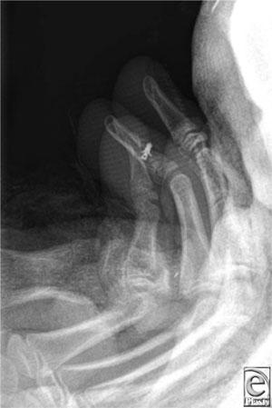 Figure 2. Image post fixation of the avulsed flexor digitorum profundus tendon with a Mitek bone anchor.
