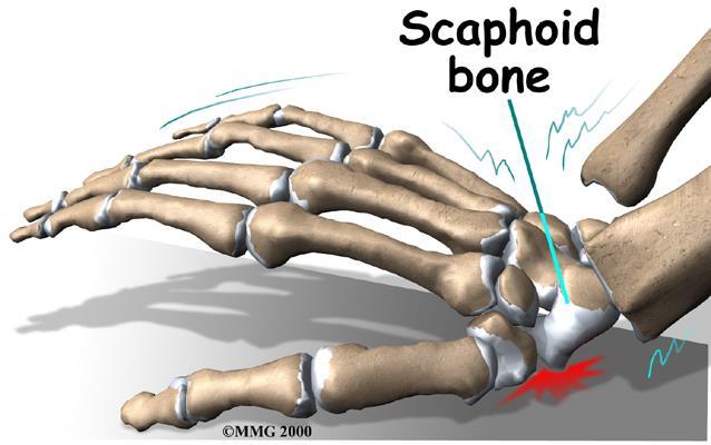 Wrist and Hand Injuries Fractures of the Wrist and Hand Scaphoid Fracture - fracture of