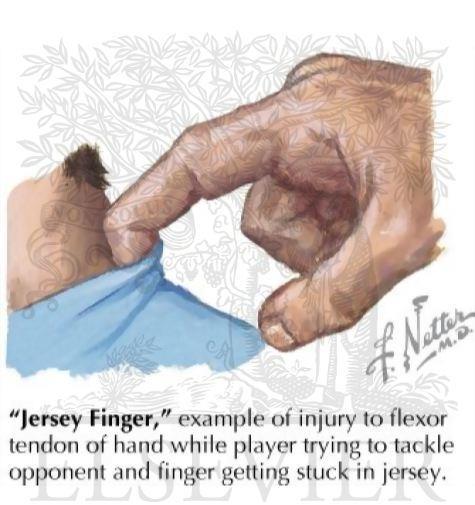 Jersey Finger- grabbing something and tearing the flexor tendon.