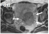 MRI anatomy: signs of parametrial invasion