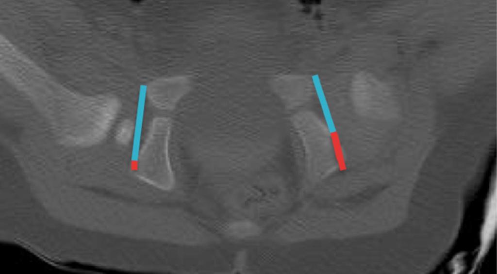 J Child Orthop (2014) 8:319 324 321 Fig. 2 Postreduction single slice CT image highlighting the acetabular ratio Fig.