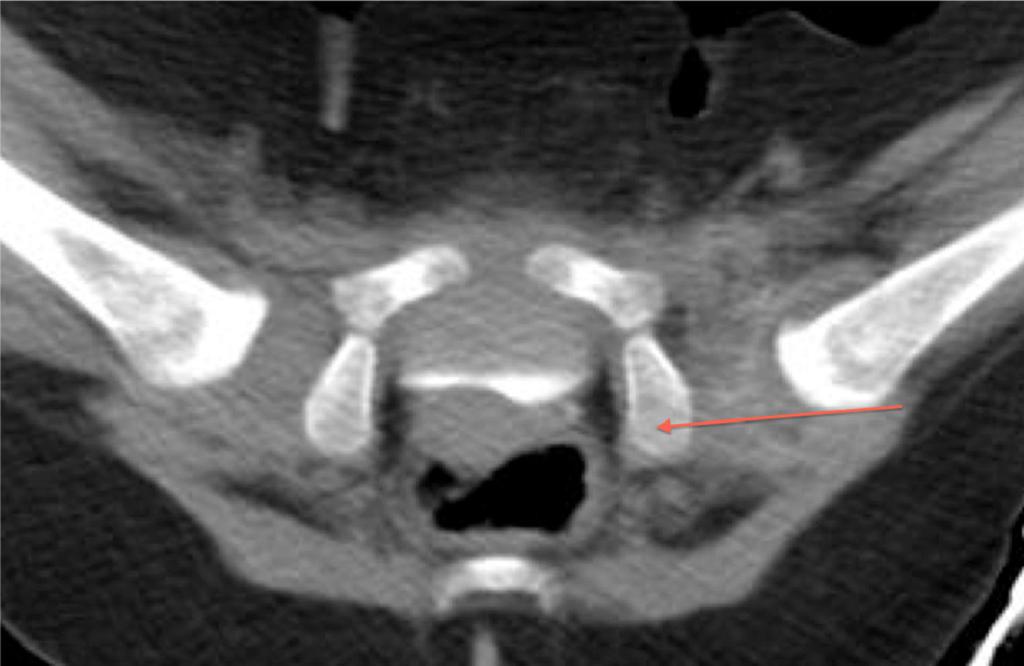 322 J Child Orthop (2014) 8:319 324 Fig. 4 Postoperative single slice CT image with the posterior neck line revealing a dislocated left hip a mean specificity of 0.88 (range 0.85 0.98).
