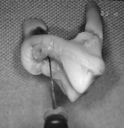 Figure #20.17. This maxillary first molar had a deformity on the crown that resulted in direct communication into the pulp chamber.