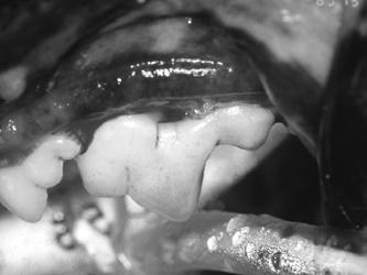 5-years of age, the endodontic infection had resulted in complete dehiscence of the bone, oral mucosa and gingiva on the buccal side of this tooth.
