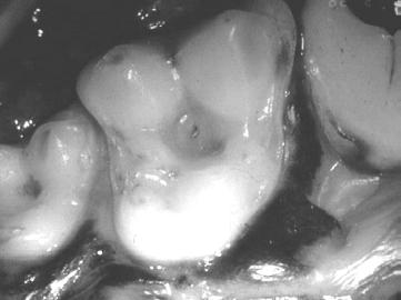 Figure #20.3. The tiny dark spot in the centre of the occlusal table of this maxillary first molar is a pit in the enamel with a caries lesion developing. This one can be restored.