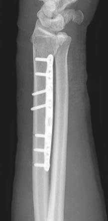 Over recent decades surgeons have utilized plate fixation for the treatment of midshaft forearm fractures.