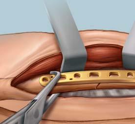 Screws should be inserted by alternating from one side of the fracture to the other.