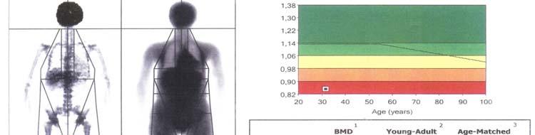 TOTAL BODY DXA 2% low BMD normal BMD 8% Mean age 2,45±7,8 (range:1-34) BONE DENSITY SCANING (DXA) IN A