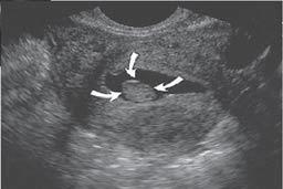 Vaginal ultrasound