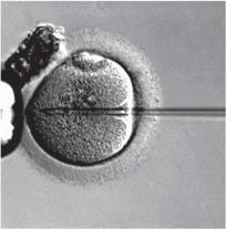 Protocol Basics of IVF Cycle Egg Retrieval
