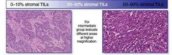 Rationale for immunotherapy in HER2- positive breast cancer HER2+ Breast Cancer are higly infiltrated