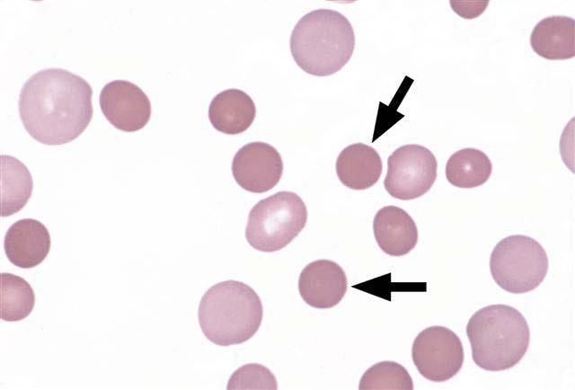 Figure 1. Polychromatophilic red cells. The three arrowed red cells show the characteristic larger size and blue-gray or basophilic color compared to the other erythrocytes in the image. Figure 2.