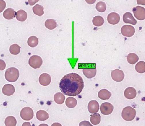 VPBS-16 Participants Identification No. % Evaluation Eosinophil 905 99.5 Educational The arrowed cell is an eosinophil, correctly identified by 99.5% of the participants.