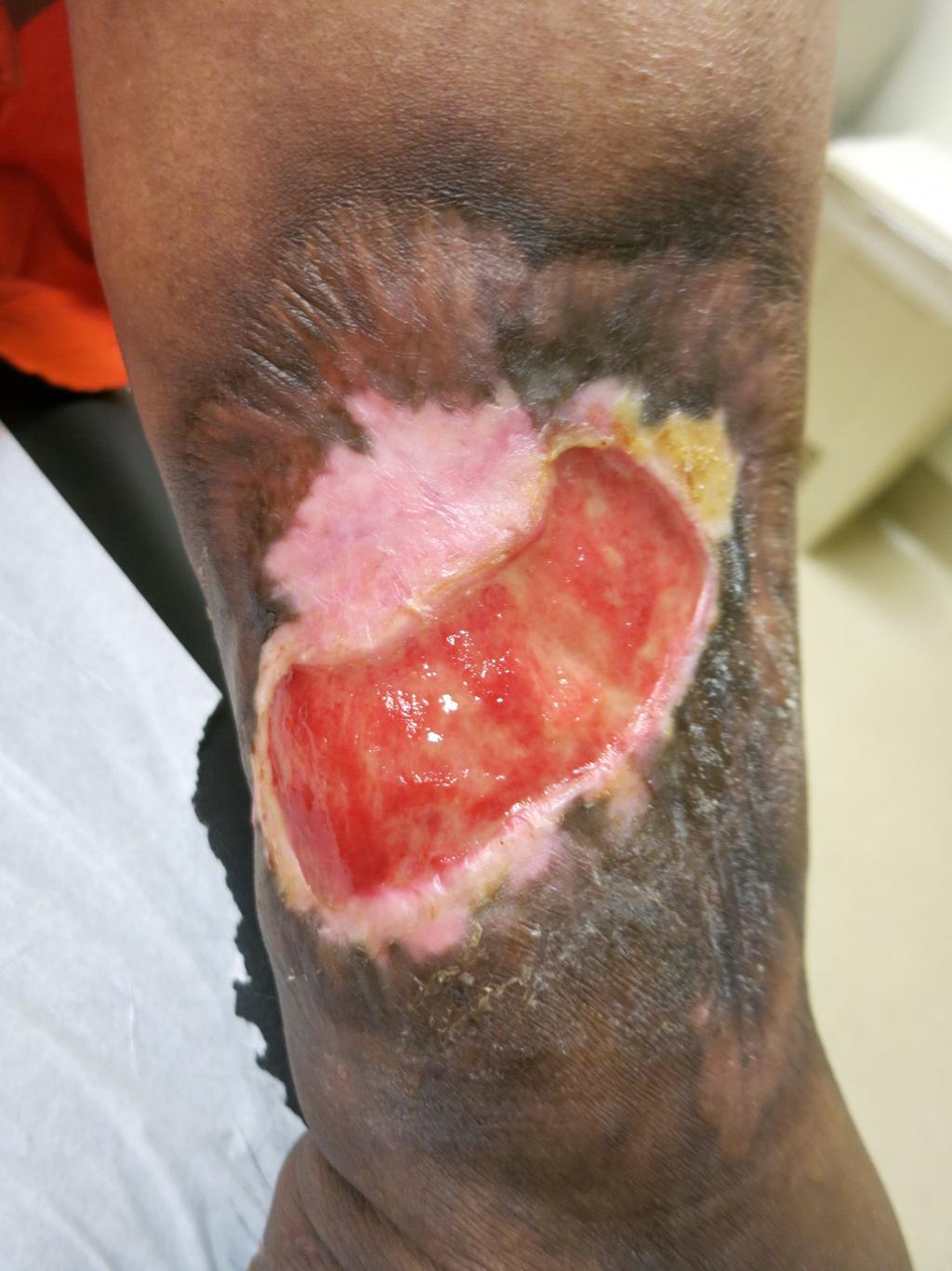 Case Example 50yo woman with pyoderma gangrenosum x 3 years Also high-titer ANA and antiphospholipid antibody positivity Has asked for pain medicine in