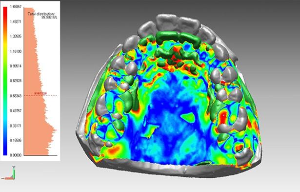 748 Cho et al American Journal of Orthodontics and Dentofacial Orthopedics December 2010 Fig 1. Superimposition of the 3D virtual models between T0 (gray) and T1 (green).