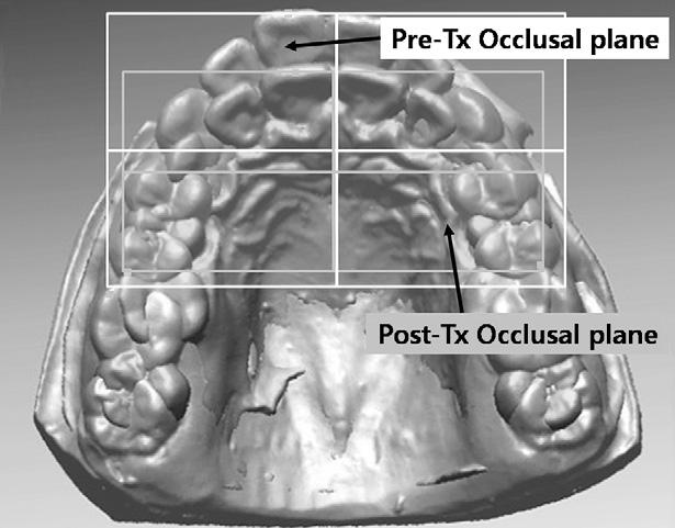 incisor and first molar between superimpositions of the lateral cephalogram and superimpositions of 3D virtual models.