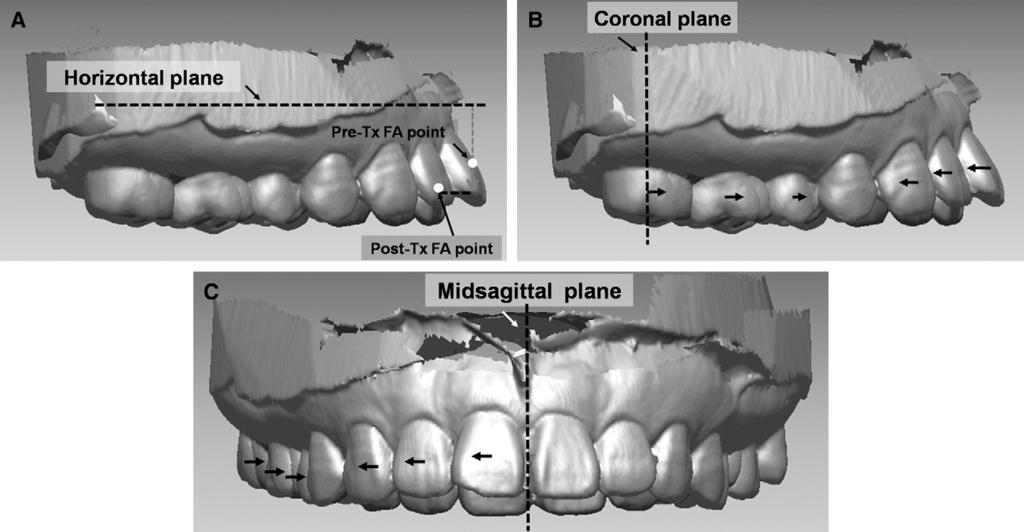 American Journal of Orthodontics and Dentofacial Orthopedics Cho et al 751 Volume 138, Number 6 Fig 7. A, Vertical displacement of FA point from the horizontal plane (mm).