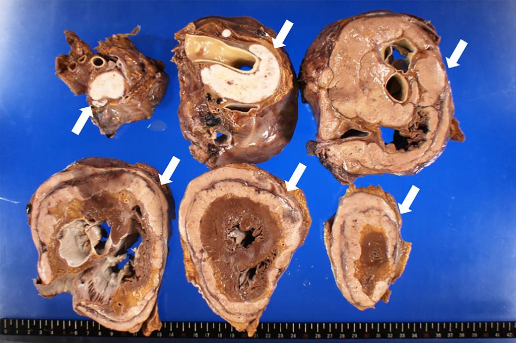 magnification, 200). Figure 6. The autopsy revealed a white solid tumor (arrows) in the pericardium around the heart. The pericardial cavity was completely occupied by the tumor.