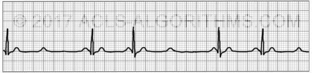 AV block: it has 3 grades (degrees), in ALL 3 of them, the P-R interval exceeds 0.20 sec. - 1 st and 2 nd degrees are known as incomplete heart block, but 3 rd degree is known as complete heart block.