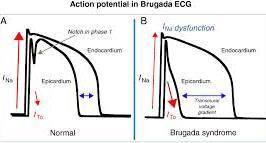 EP has been questioned Typical ventricular arrhythmia in Brugada syndrome is a polymorphic ventricular tachycardia, that can evolve into ventricular fibrillation Mechanism: phase 2 reentry Closely