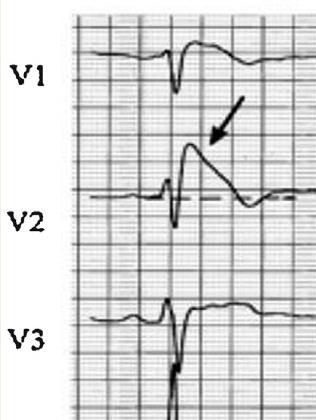 BrS: Diagnosis 5:10000 First described in 1992 by Brugada brothers genetic basis established in 1998 coved elevation incomplete RBBB in right